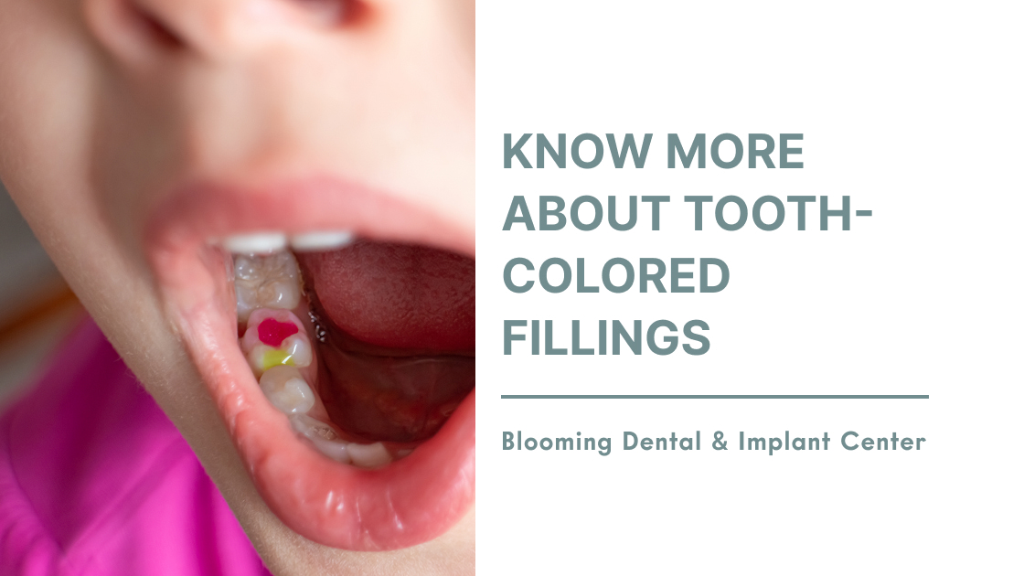 Know More About Tooth-Colored Fillings