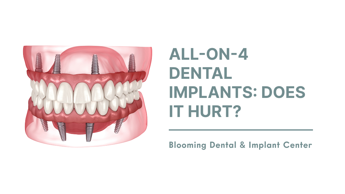 All-On-4 Dental Implants: Does It Hurt?