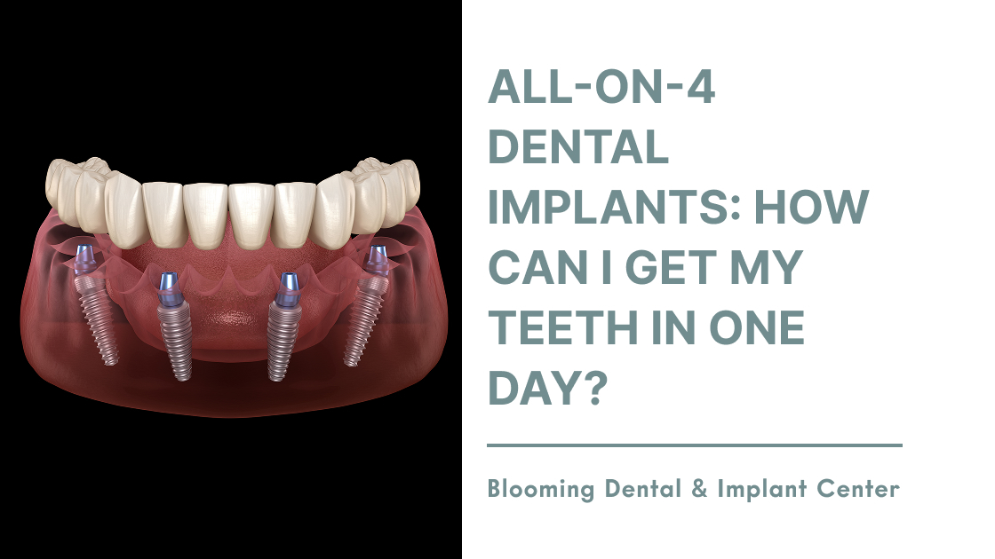 All-On-4 Dental Implants: How Can I Get My Teeth In One Day?