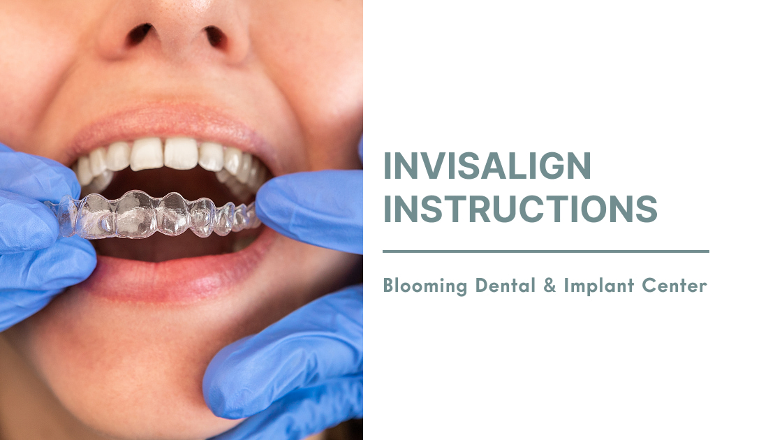 Invisalign Instructions