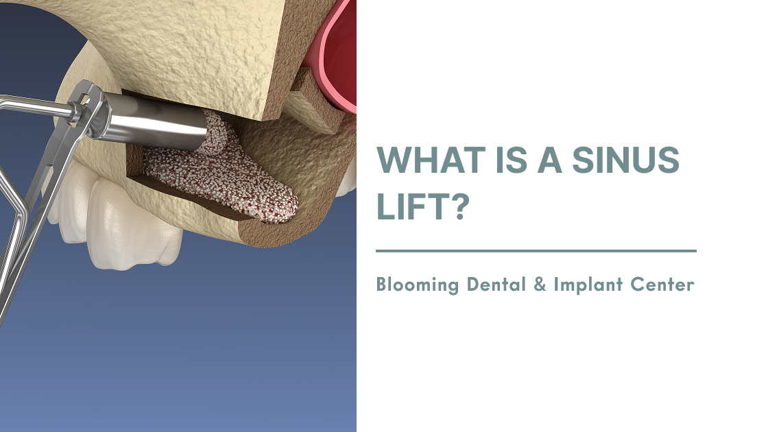 What is a Sinus Lift?