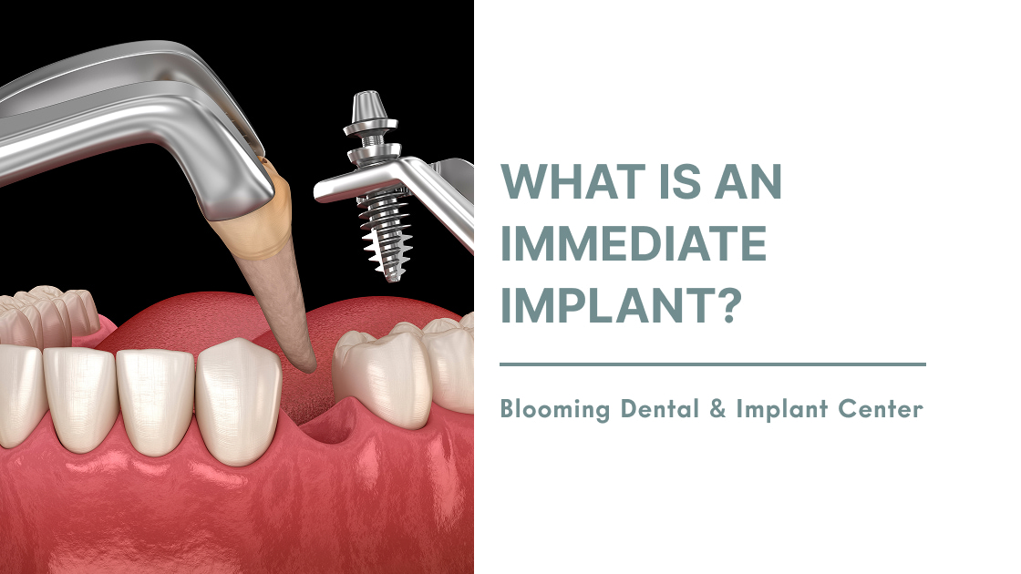 What is an Immediate Implant?