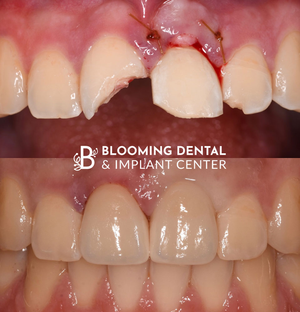 Same Day Tooth Replacement image