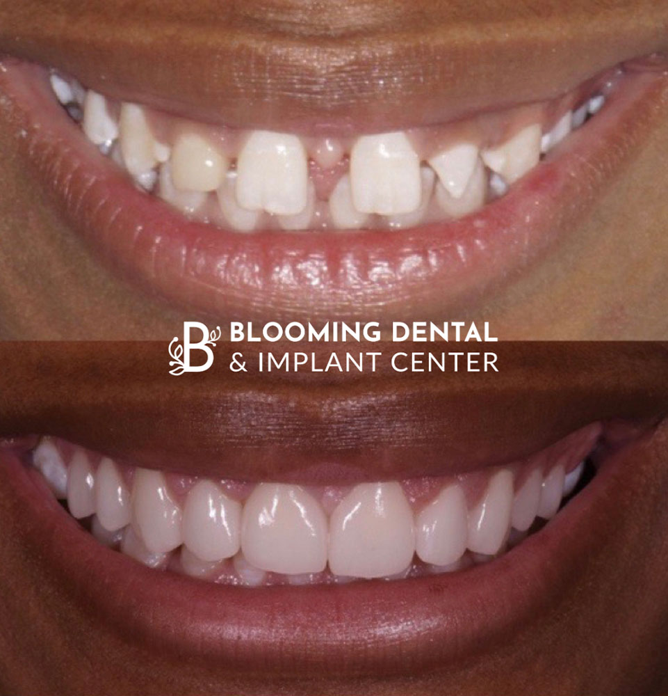 before and after teeth image