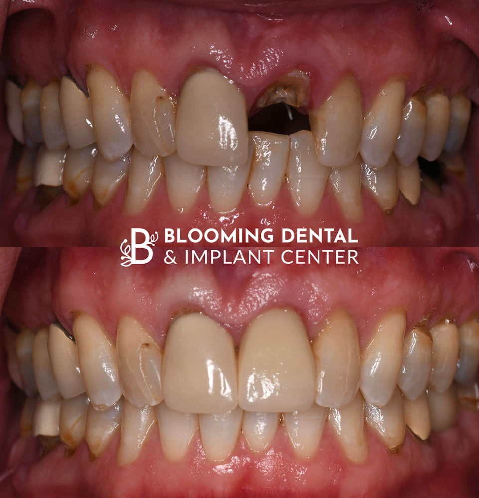 What If I Need A Front Tooth Replaced image