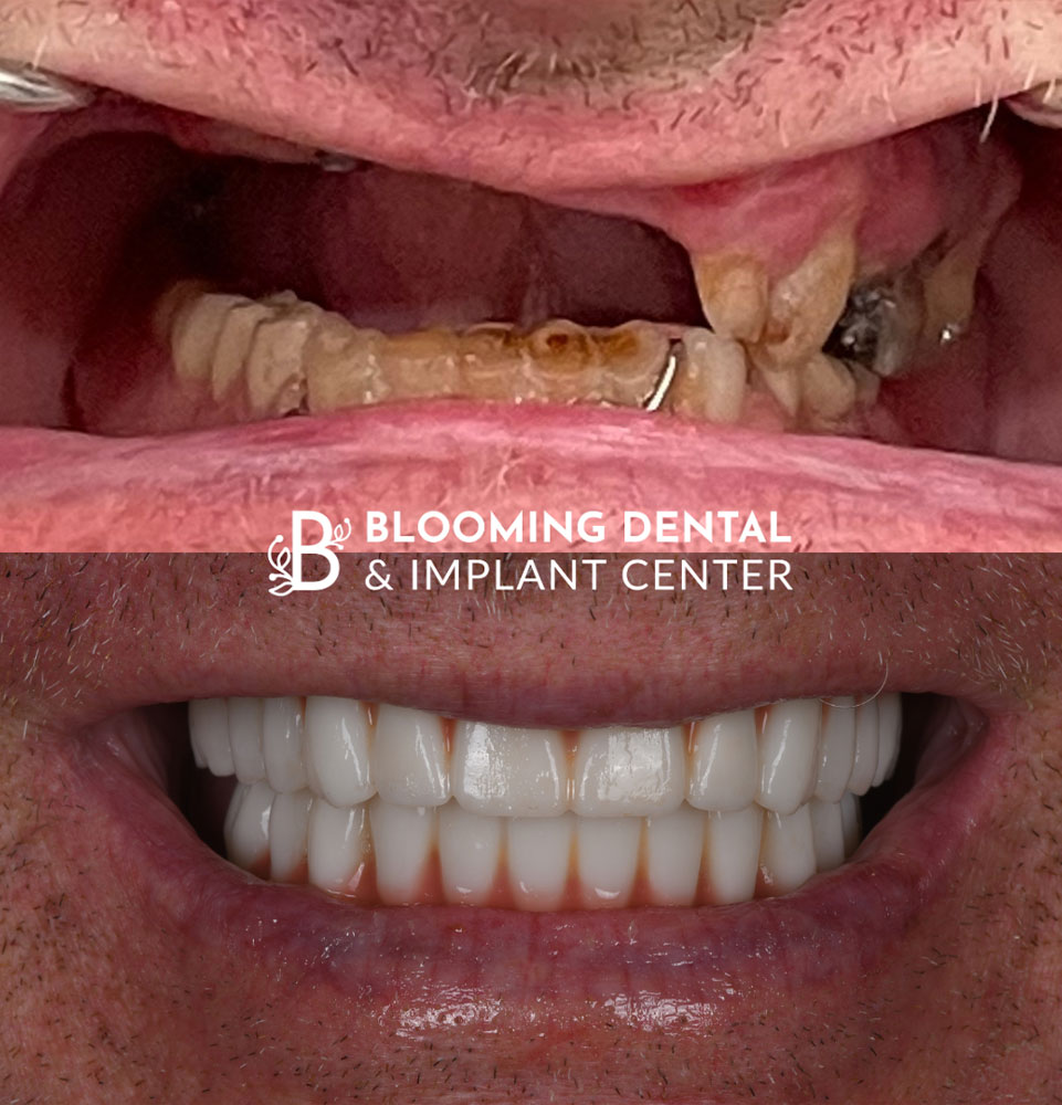 before and after full mouth dental implant