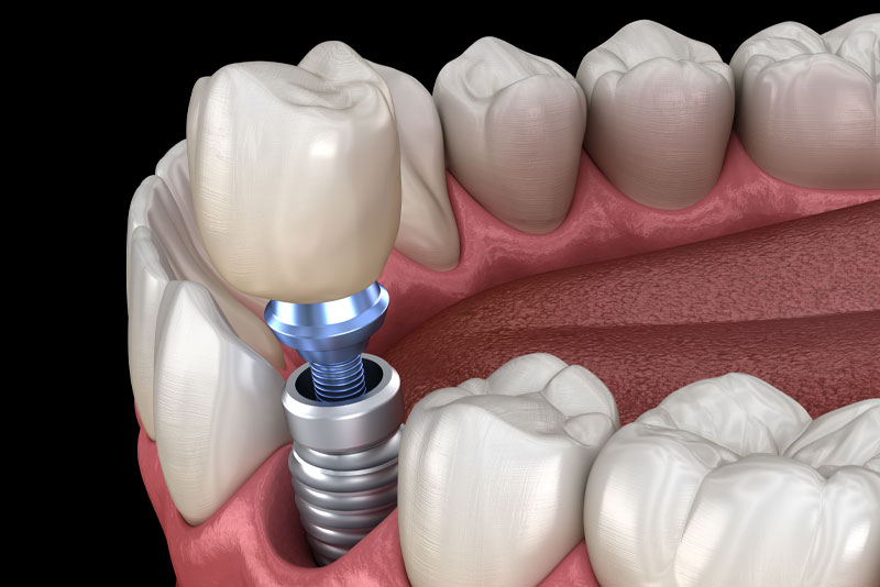 Single Dental Implants