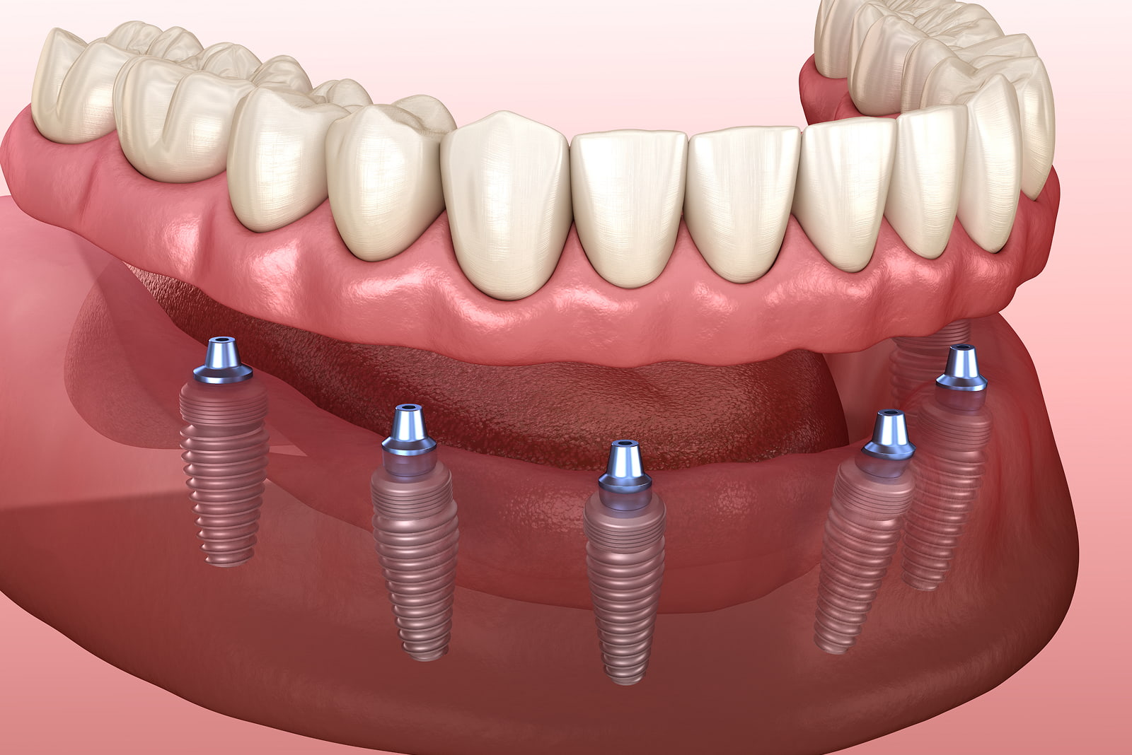 Implant Supported Dentures
