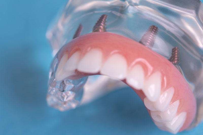 Full-Arch Dental Implants