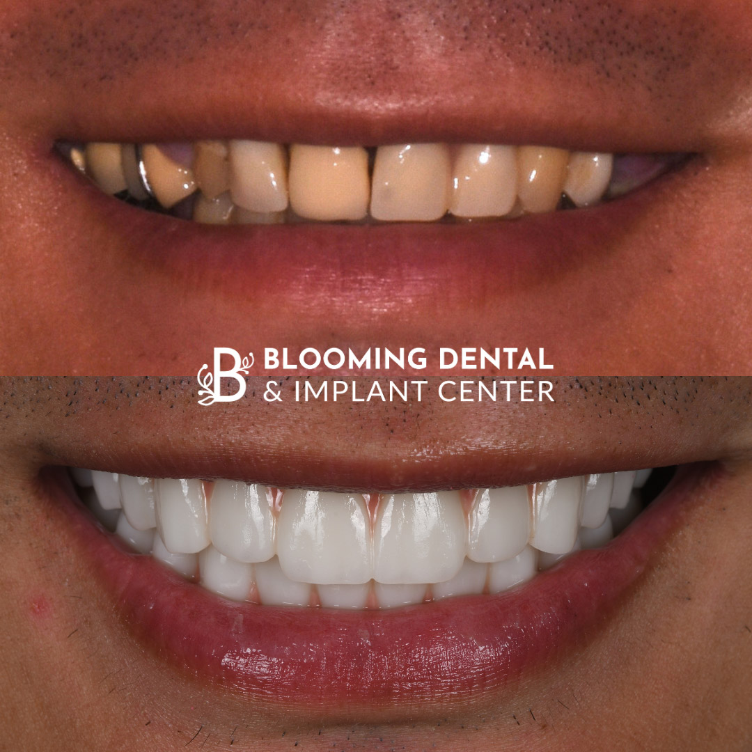 Full Mouth Dental Implant Image 100