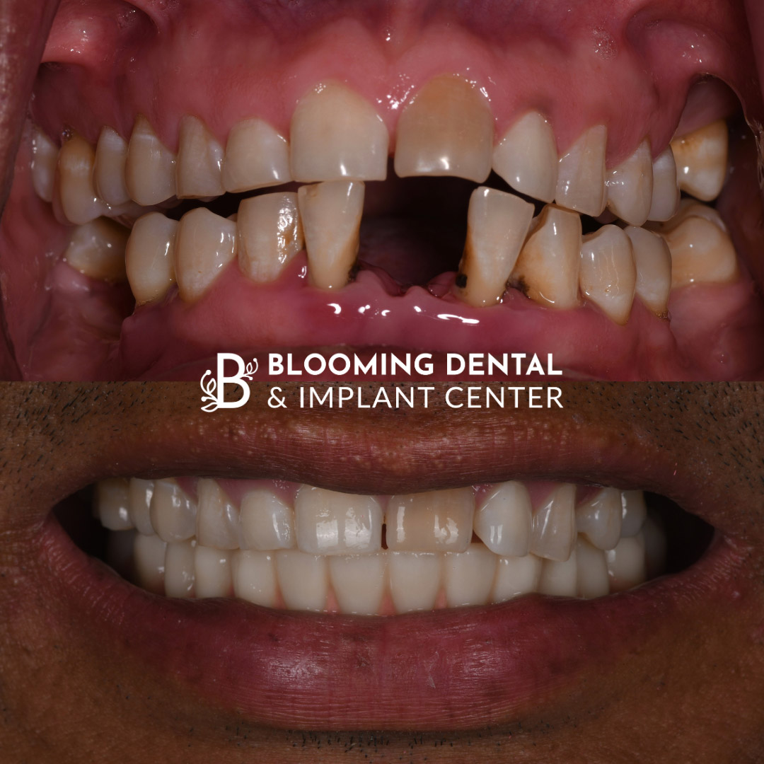 Full Mouth Dental Implant Image 102