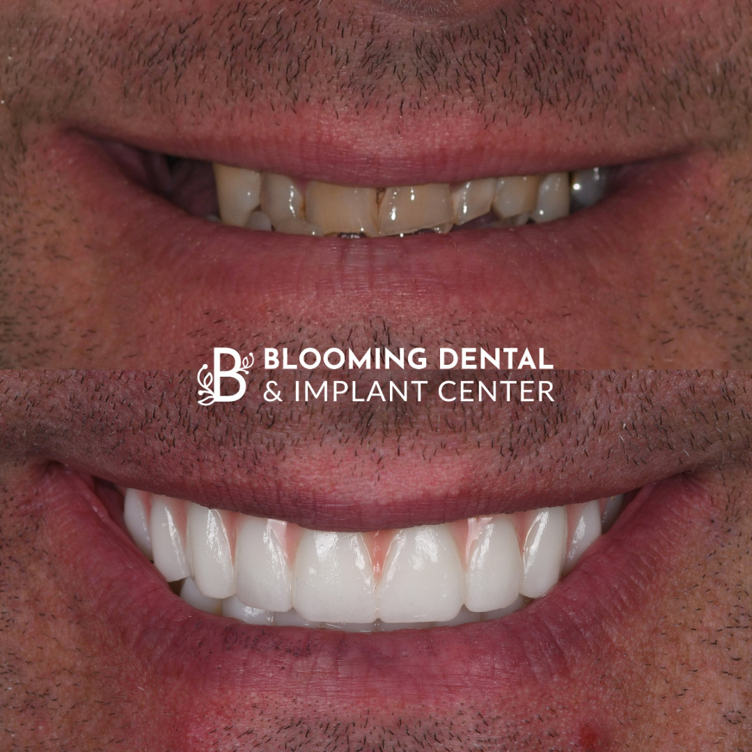 Full Mouth Dental Implant Image 103