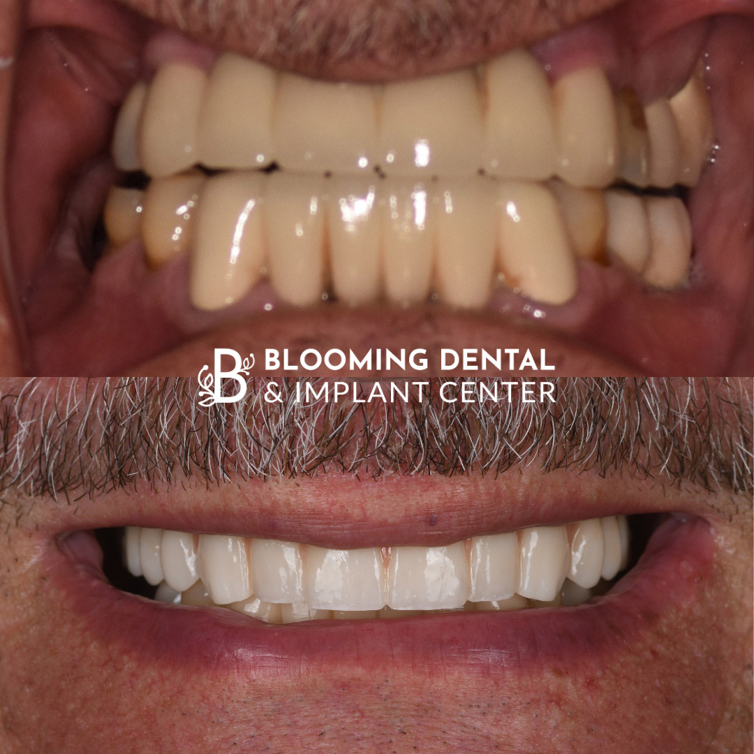 Full Mouth Dental Implant Image 104