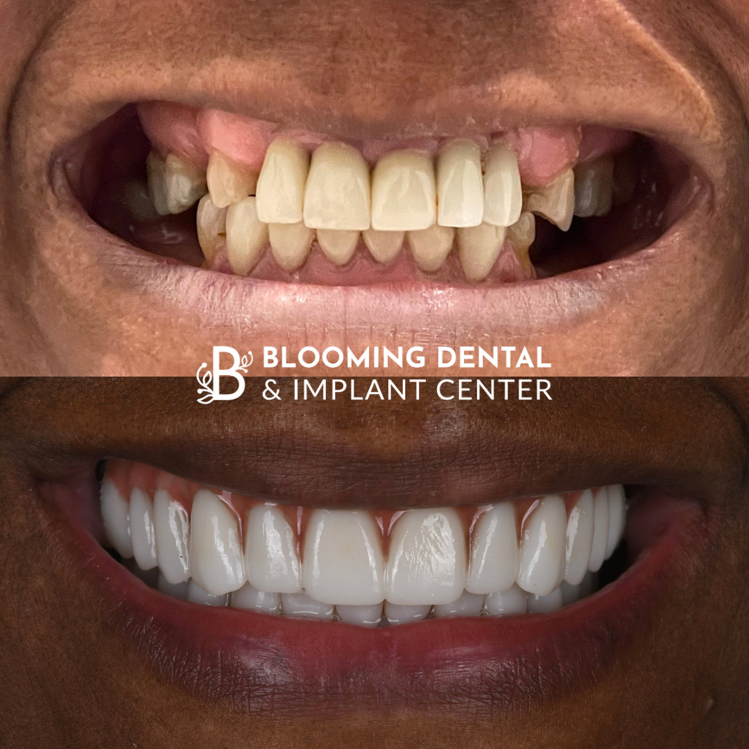 Full Mouth Dental Implant Image 105