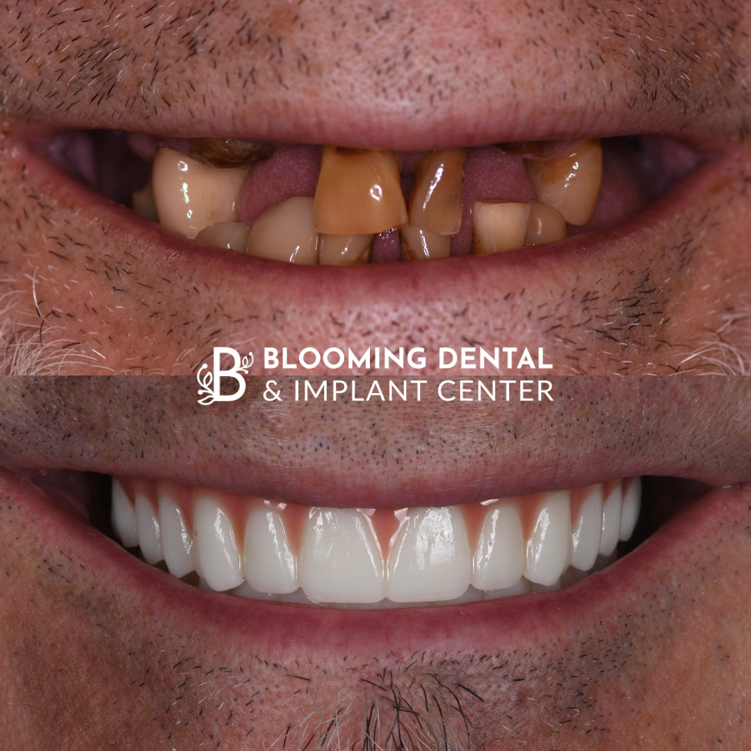 Full Mouth Dental Implant Image 106