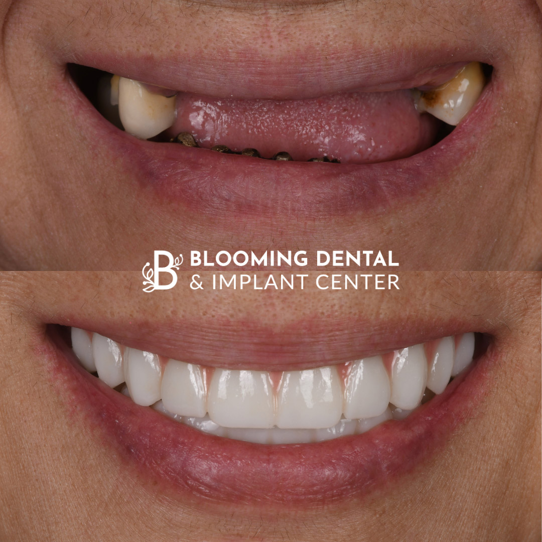 Full Mouth Dental Implant Image 107