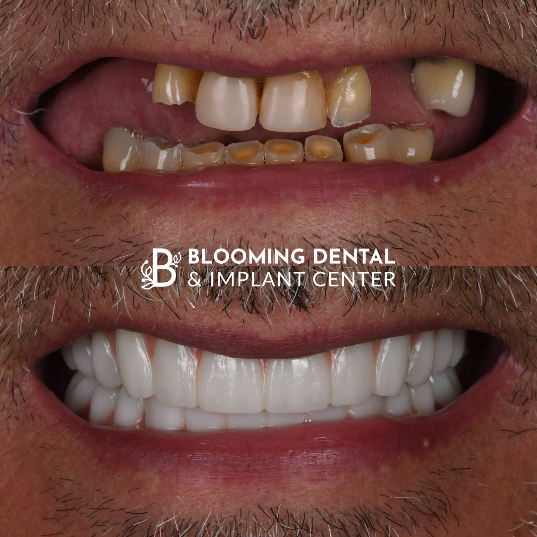 Full Mouth Dental Implant Image 108