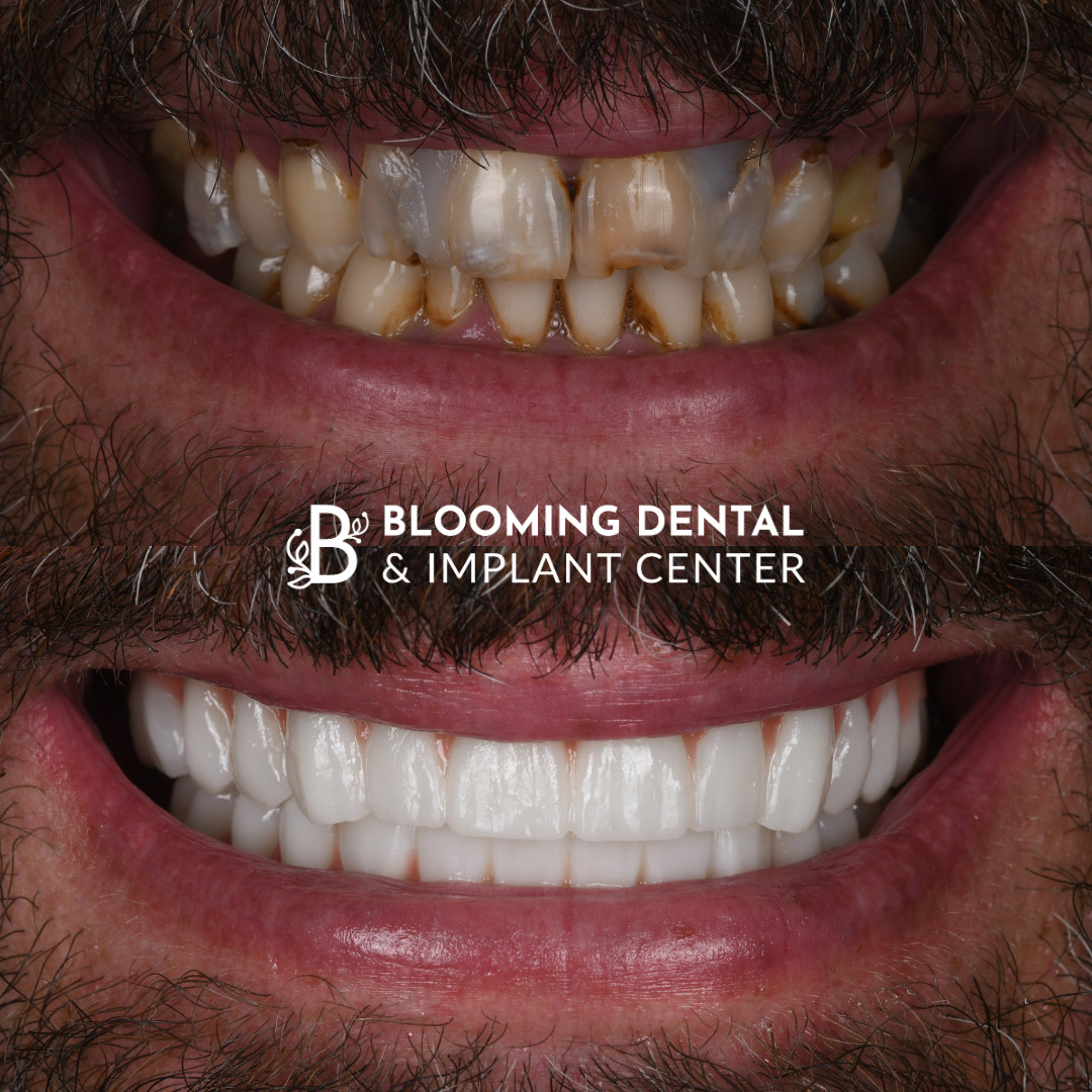 Full Mouth Dental Implant Image 109