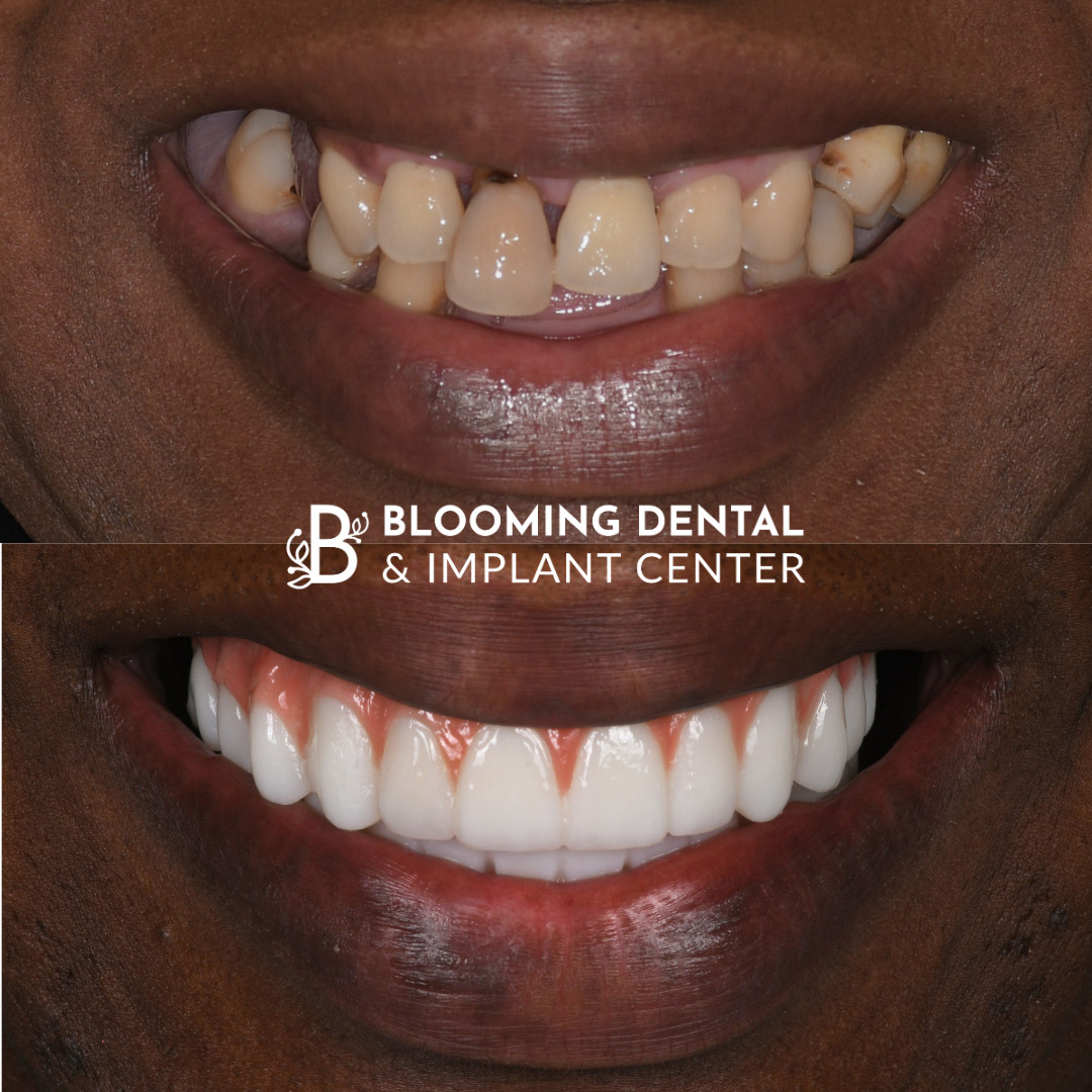 Full Mouth Dental Implant Image 110