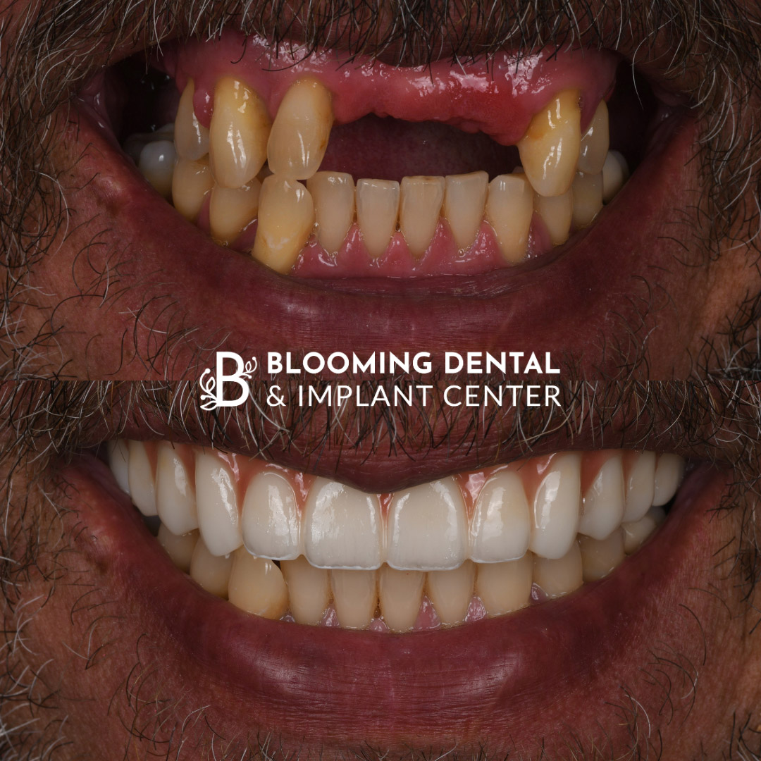 Full Mouth Dental Implant Image 112