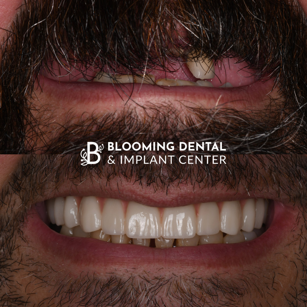 Full Mouth Dental Implant Image 113