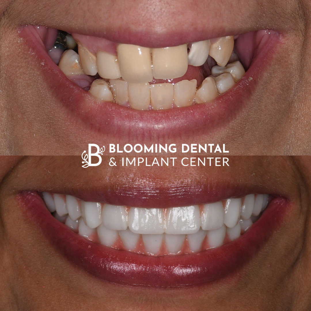 Full Mouth Dental Implant Image 115