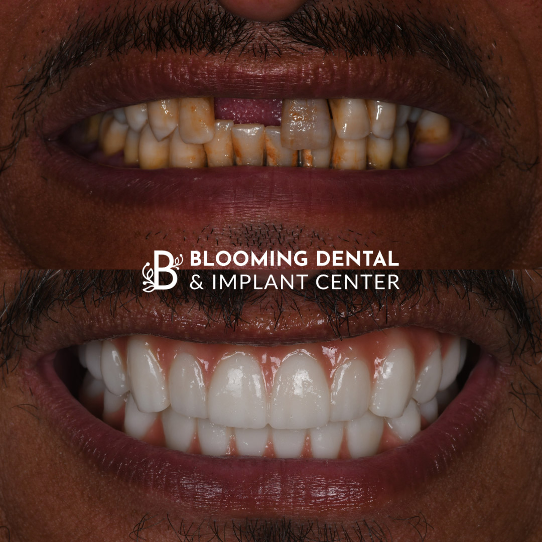 Full Mouth Dental Implant Image 116