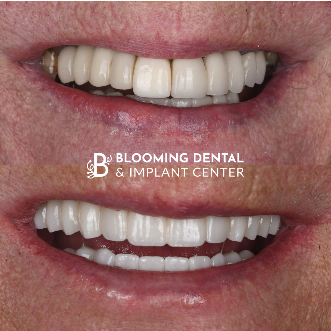 Full Mouth Dental Implant Image 118