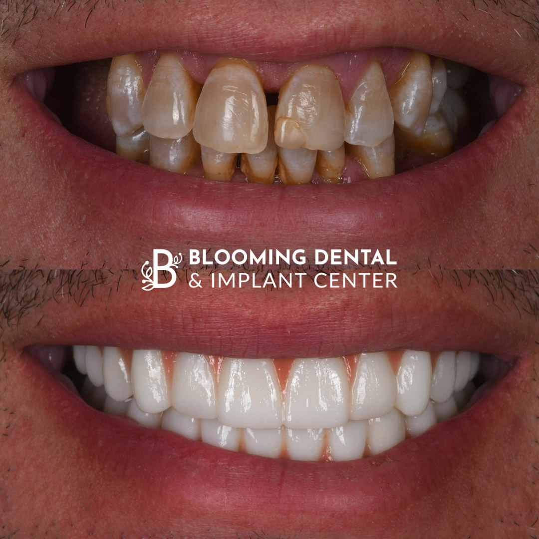 Full Mouth Dental Implant Image 119