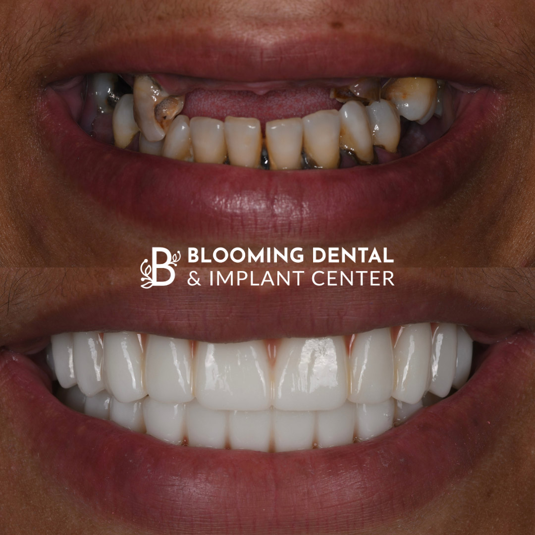 Full Mouth Dental Implant Image 74