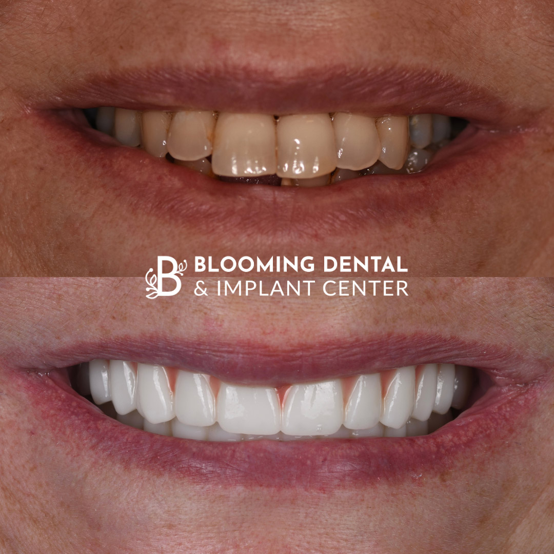 Full Mouth Dental Implant Image 75