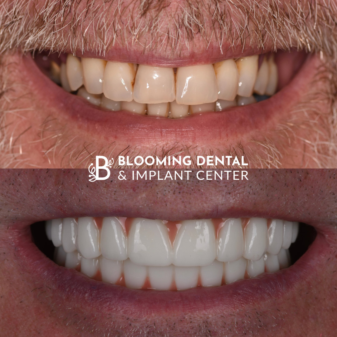 Full Mouth Dental Implant Image 76