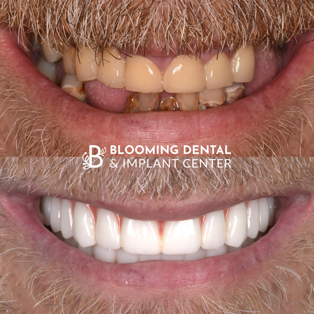 Full Mouth Dental Implant Image 77