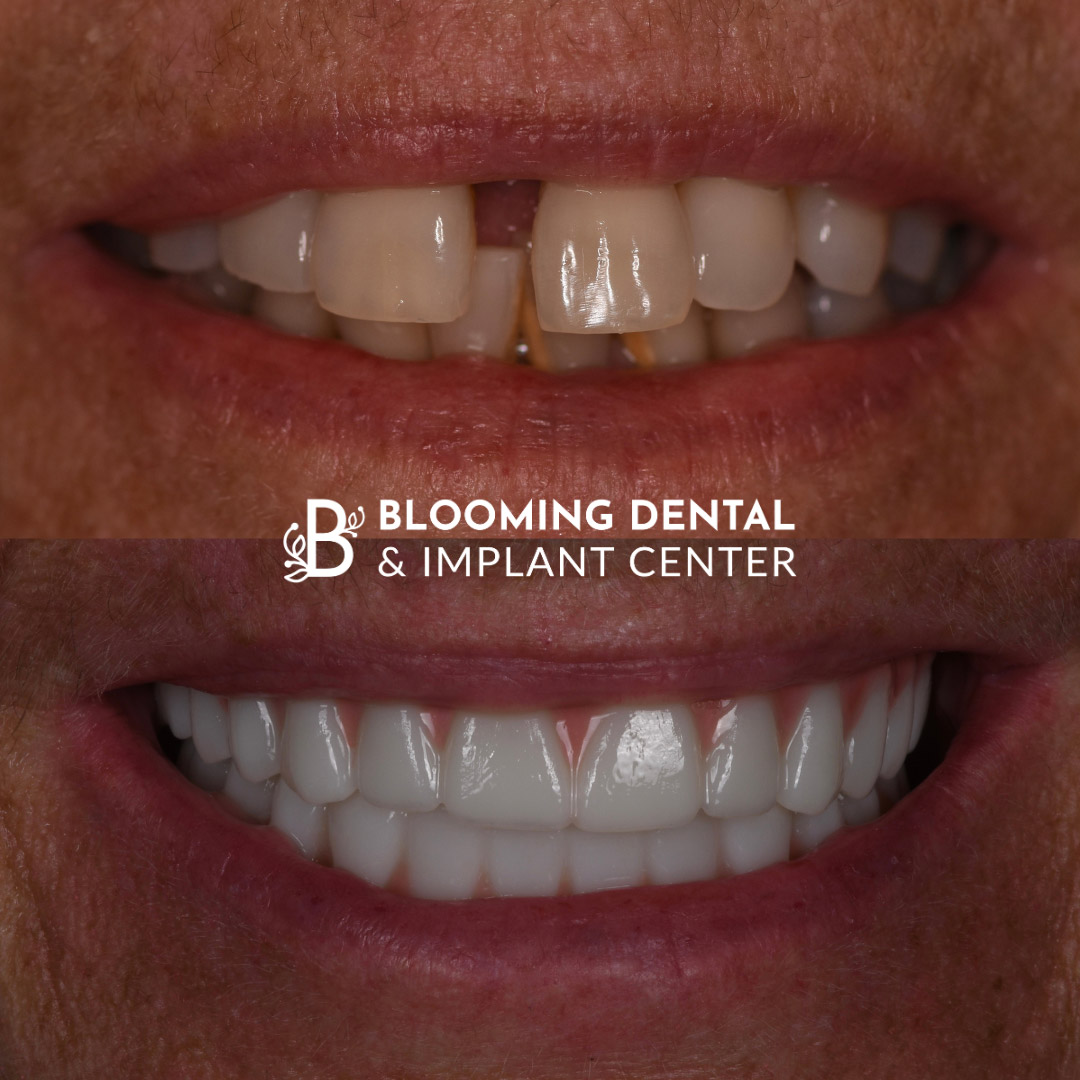 Full Mouth Dental Implant Image 78