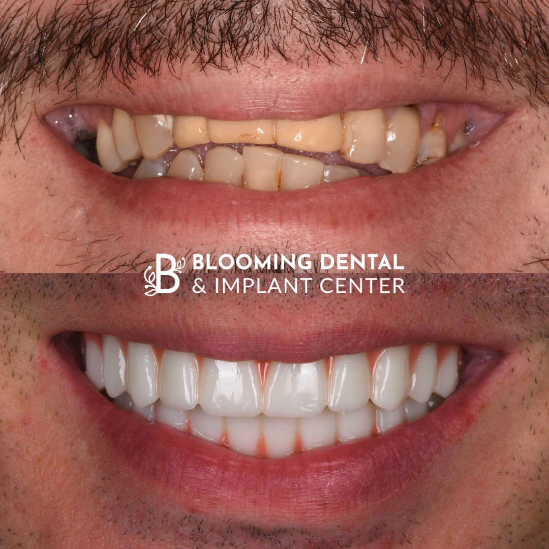 Full Mouth Dental Implant Image 80