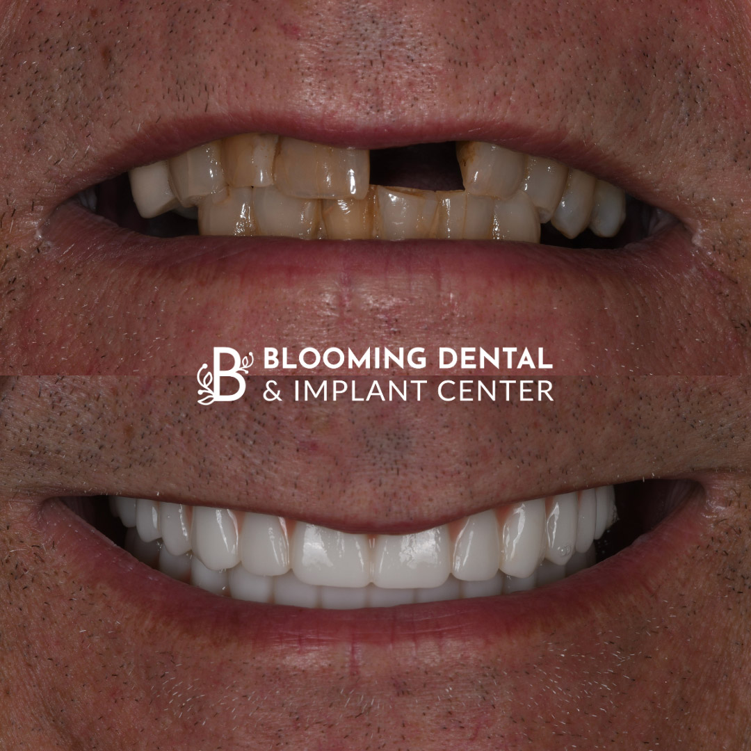 Full Mouth Dental Implant Image 81