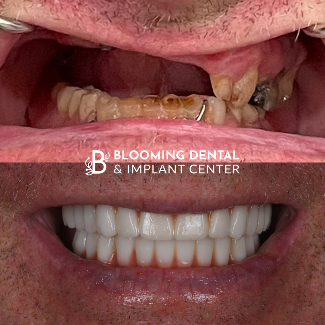 Full Mouth Dental Implant Image 82