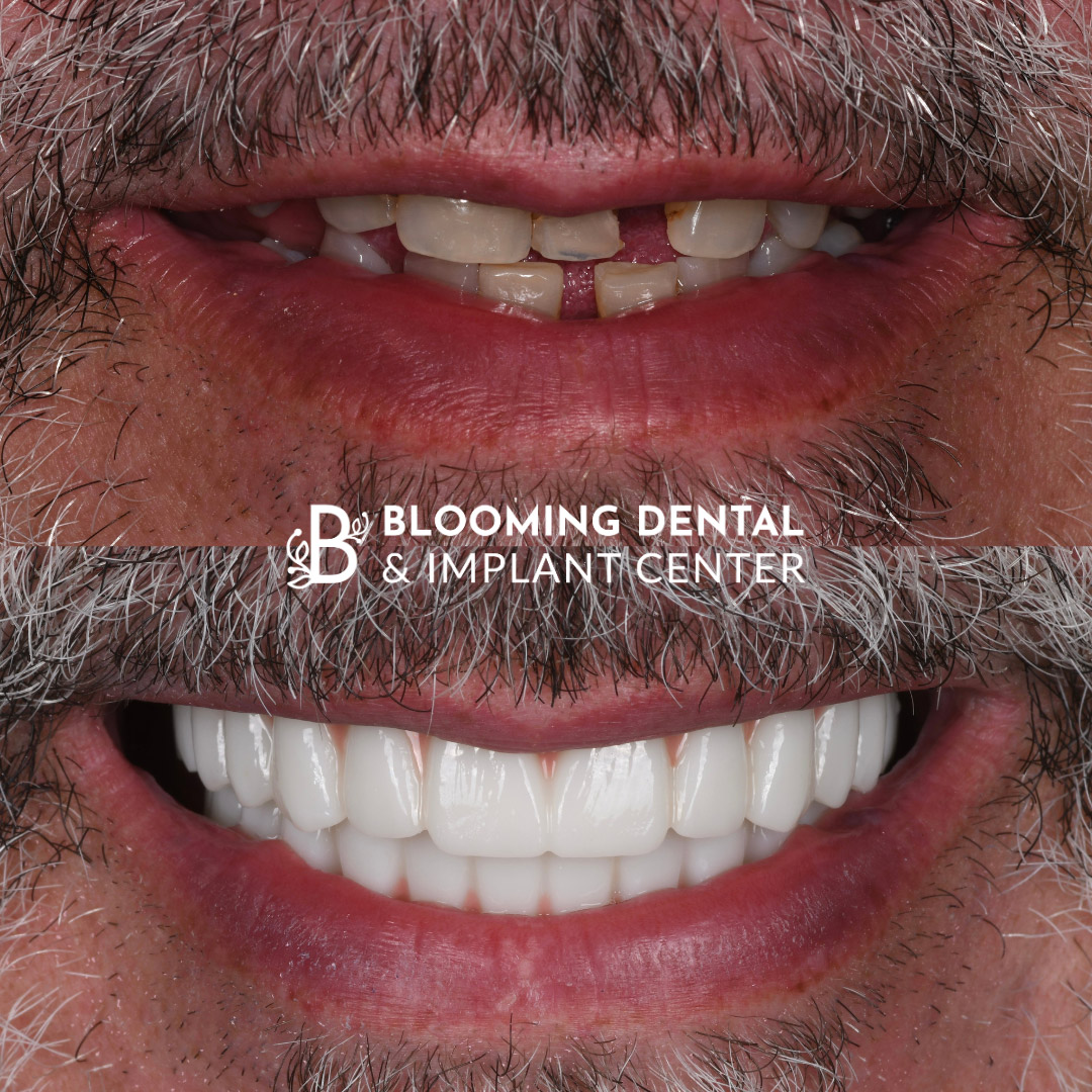 Full Mouth Dental Implant Image 83