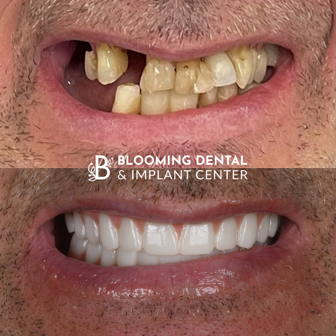Full Mouth Dental Implant Image 84