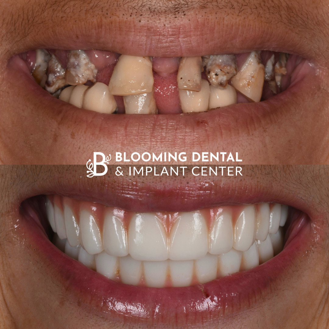 Full Mouth Dental Implant Image 86