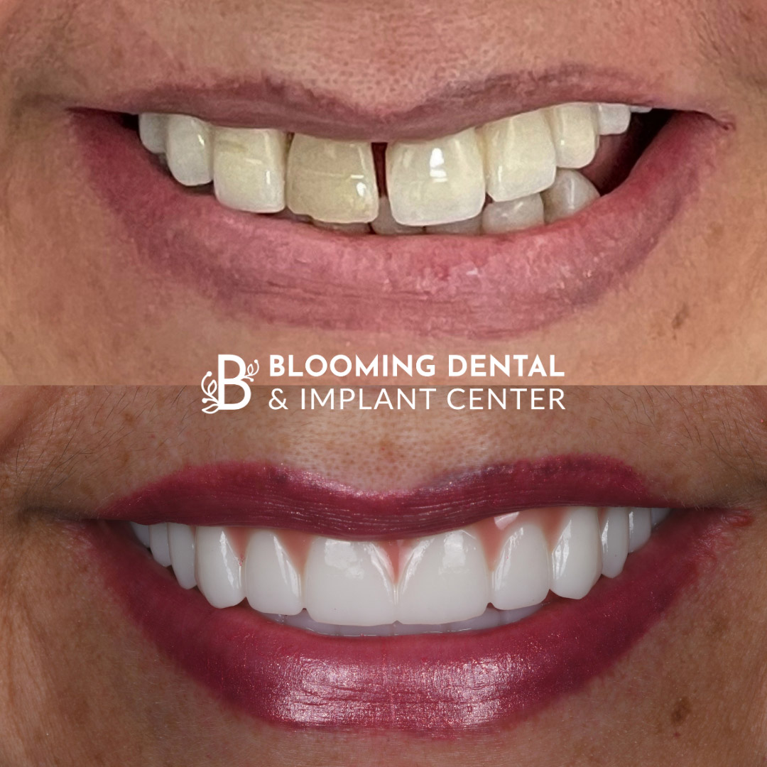 Full Mouth Dental Implant Image 87