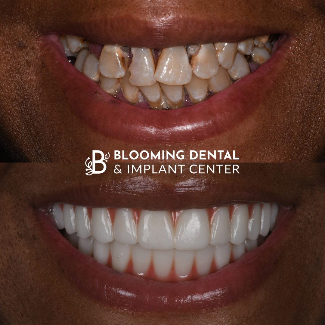 Full Mouth Dental Implant Image 88