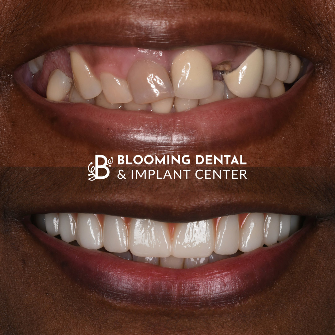 Full Mouth Dental Implant Image 89