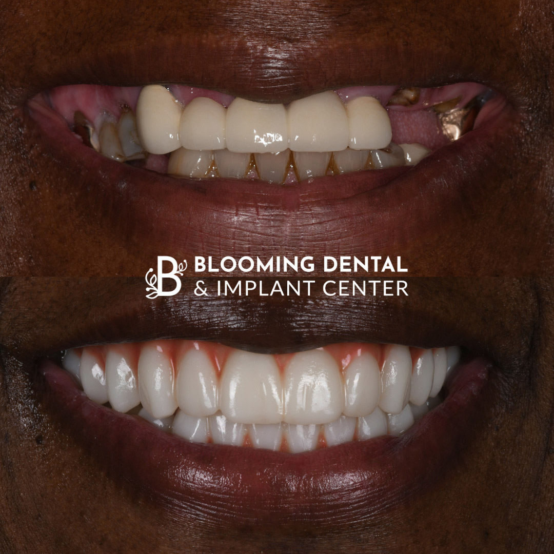 Full Mouth Dental Implant Image 90