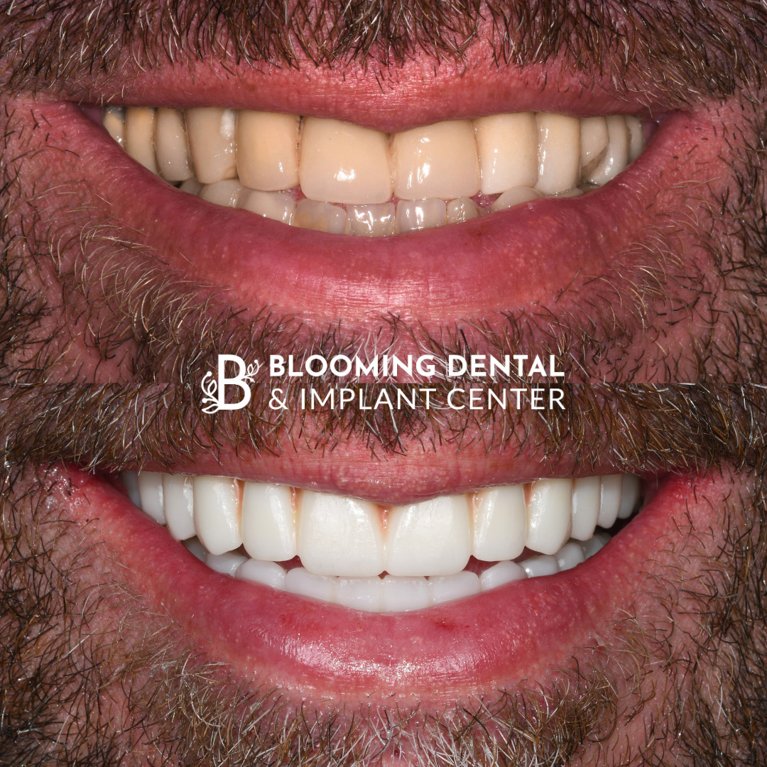 Full Mouth Dental Implant Image 91