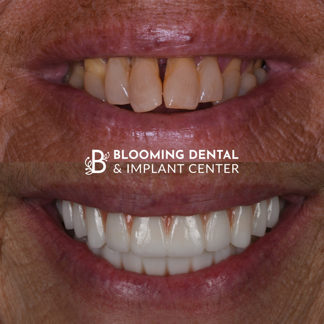 Full Mouth Dental Implant Image 92