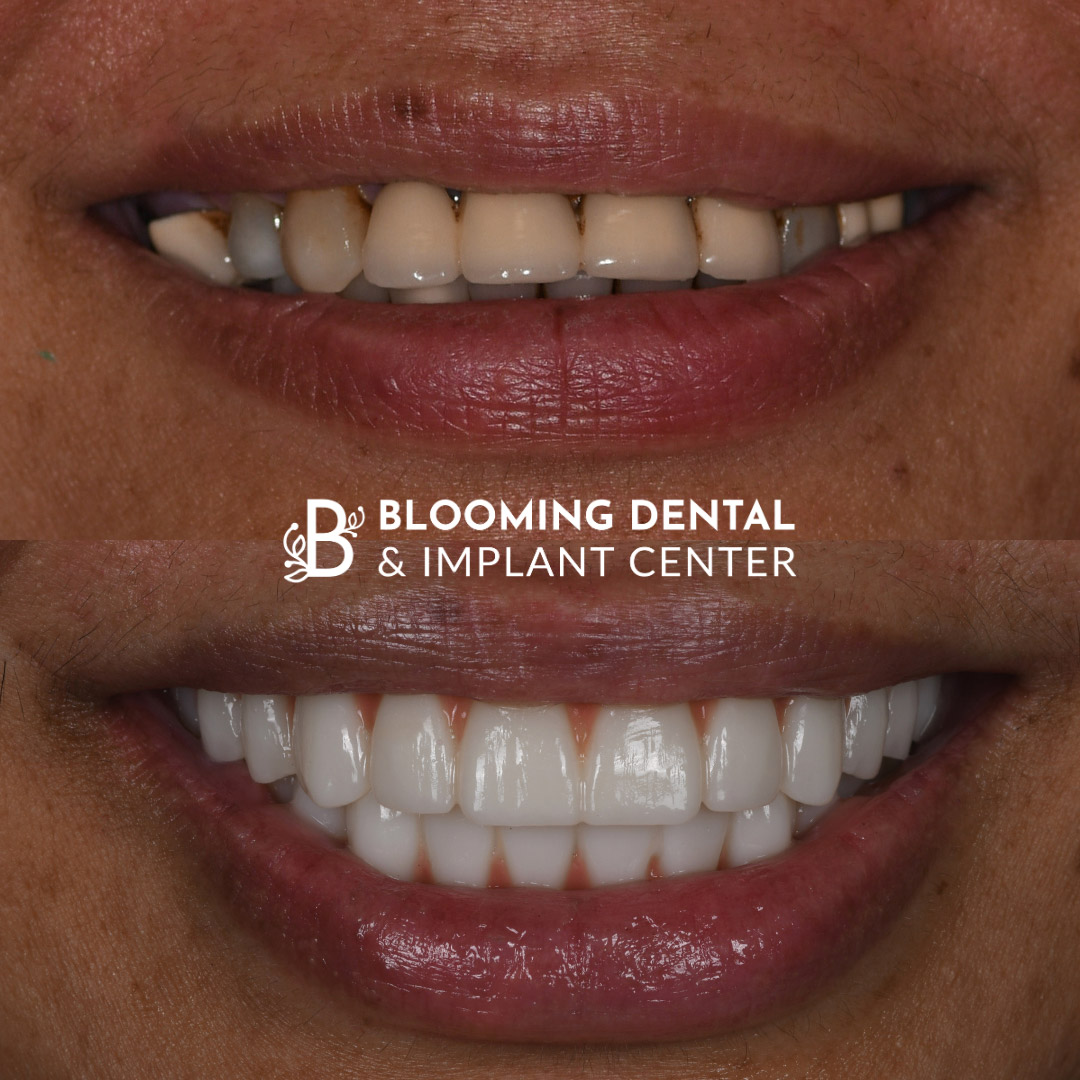 Full Mouth Dental Implant Image 93