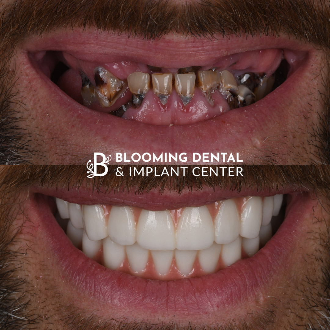 Full Mouth Dental Implant Image 94