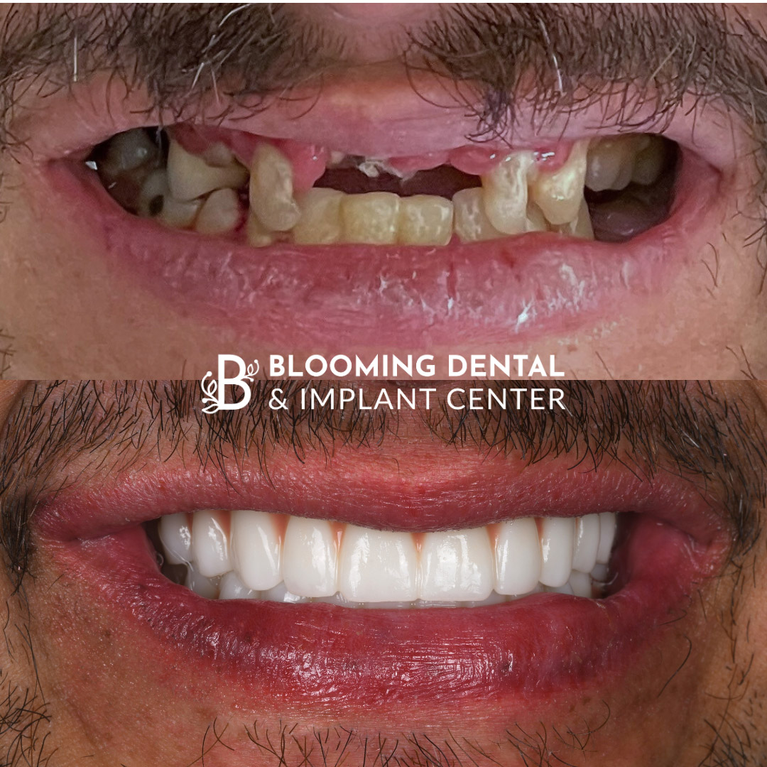 Full Mouth Dental Implant Image 95