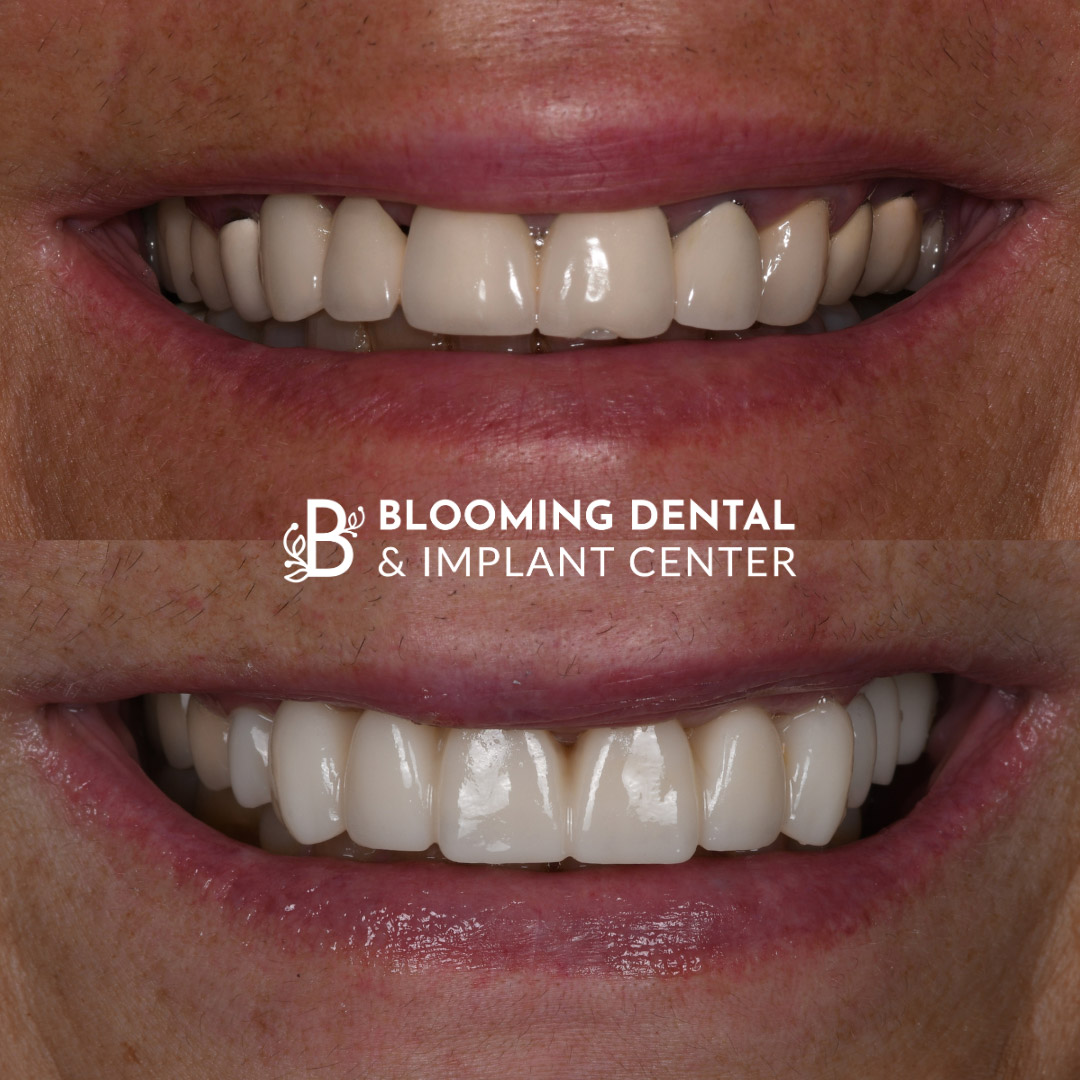 Full Mouth Dental Implant Image 96